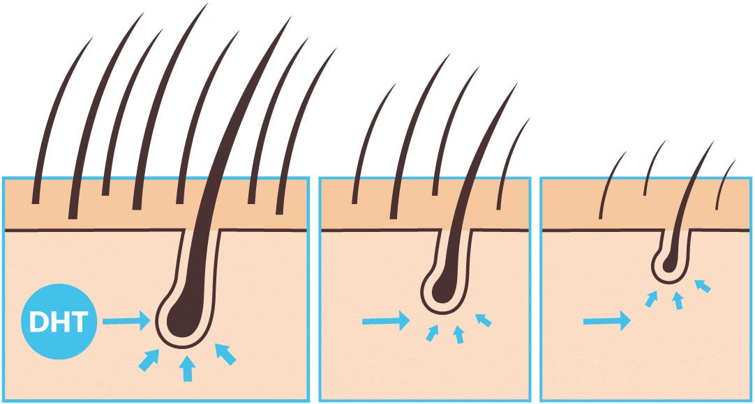 DHT - vplyv na vlasové korienky