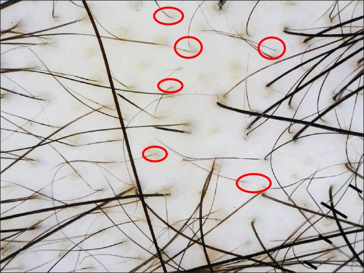 trichogram - detail vyrastajúcich vlasov z pokožky na mieste vypadávania. Zakrúžkované sú jemné vlasy.