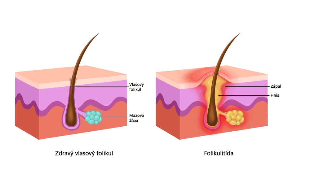 Porovnanie zdravý vlasový korienok a vlasový korienok so zápalom - folikulitídou