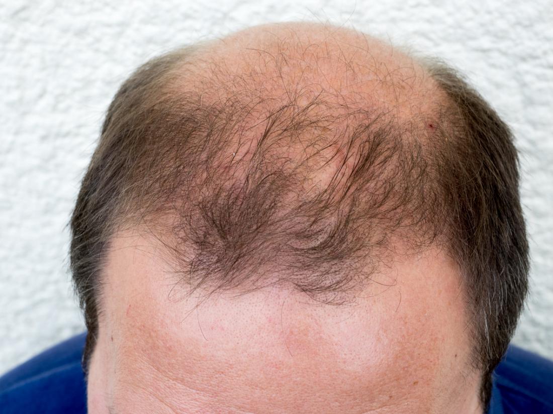 dedičné vypadávanie vlasov postihuje kúty a temeno hlavy