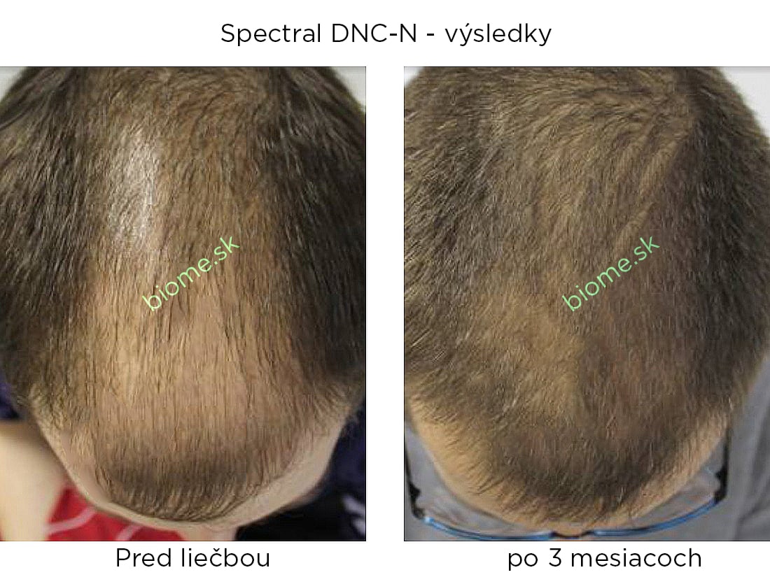 výsledky používania produktu spectral DNCN s nanoxidilom u mužov po 3 mesiacoch