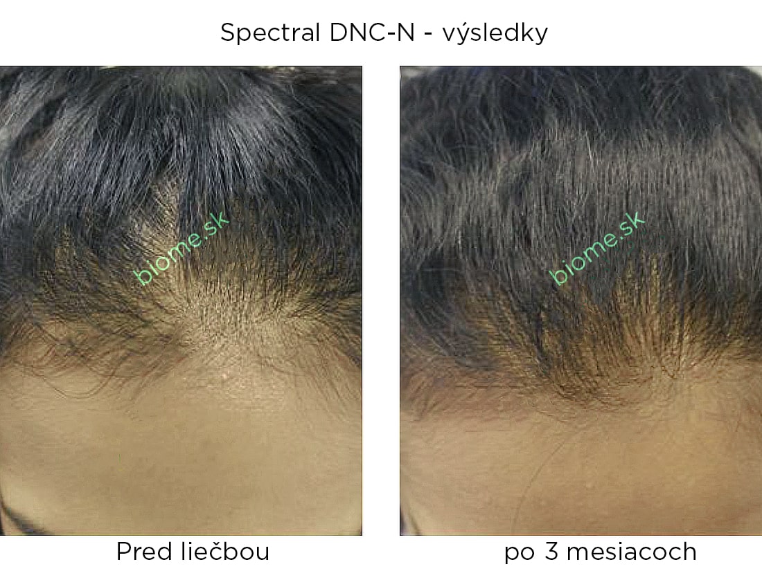 výsledky používania produktu spectral DNCN s nanoxidilom u žien po 3 mesiacoch